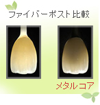 審美歯科のファイバーポスト