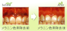 レーザー治療による歯ぐきの(黒ずみ)メラニン色素除去