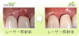 レーザー治療による歯周病(歯槽膿漏)治療