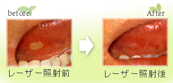 レーザー治療による口内炎治療