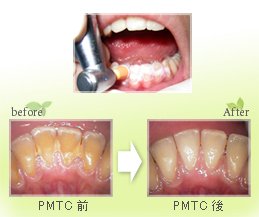 予防歯科 PMTC